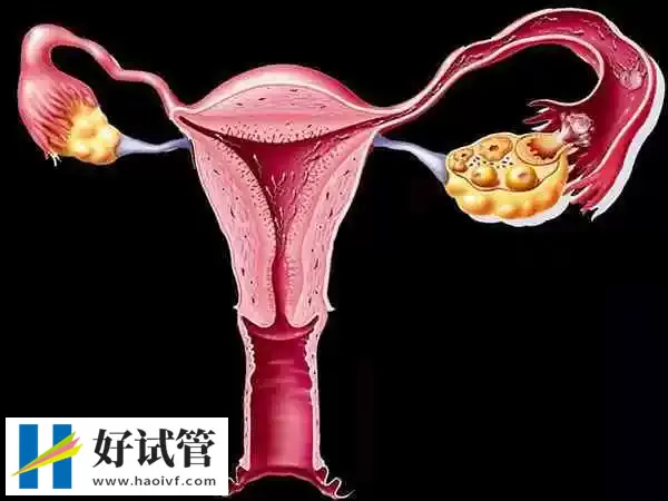 凉山输卵管不孕试管婴儿成功率多少(图1) 输卵管堵塞是不孕常见原因