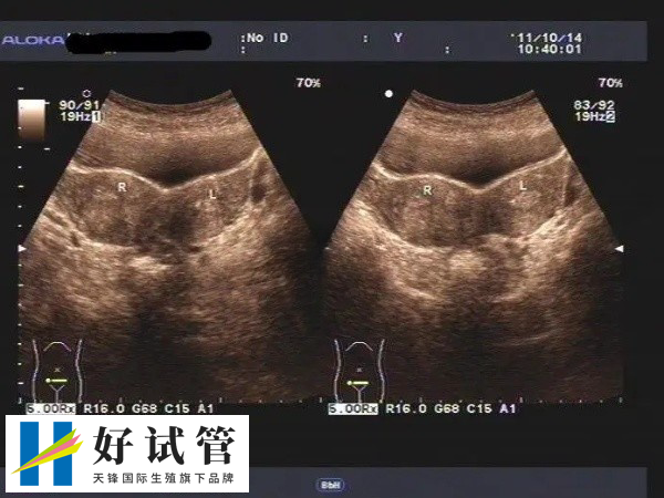 荆州中心医院试管双胞胎费用(图1) 荆州中心医院试管不一定生双胞胎