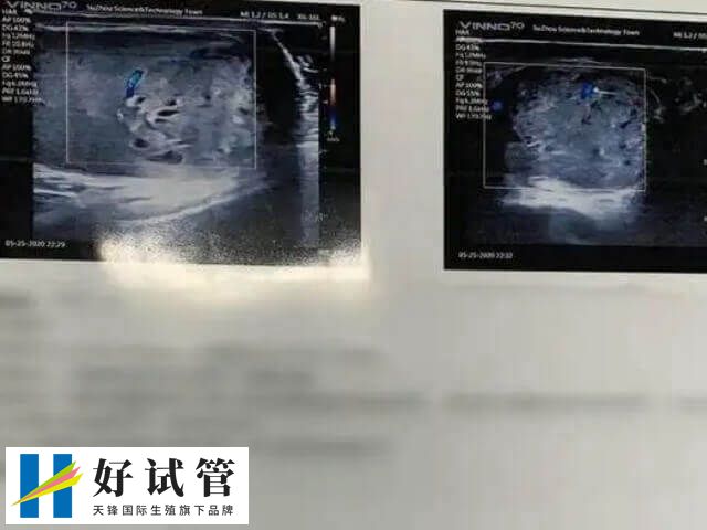 子宫内膜薄做试管移植能否成功(图1) 子宫内膜的厚度对于试管的成功至关重要