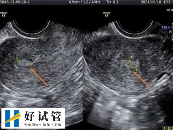 子宫内膜回声不均匀可能存在息肉