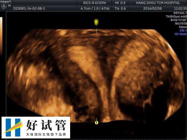 单胚胎和多胚胎移植哪个好(图2) 单胚胎移植可显著降低多胎妊娠风险