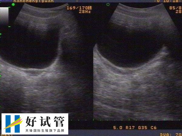 纵隔子宫可以通过治疗辅助怀孕