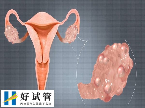 试管前需不需要结扎输卵管(图1) 输卵管存在炎症大部分会有积水