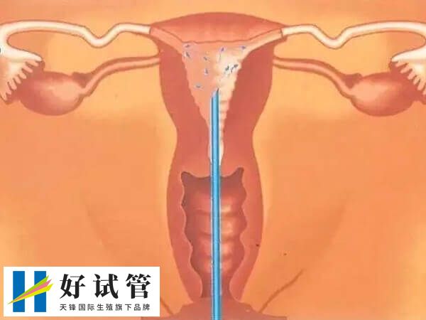 石家庄做人工授精费用多少(图1) 石家庄人工授精手术要一两千元